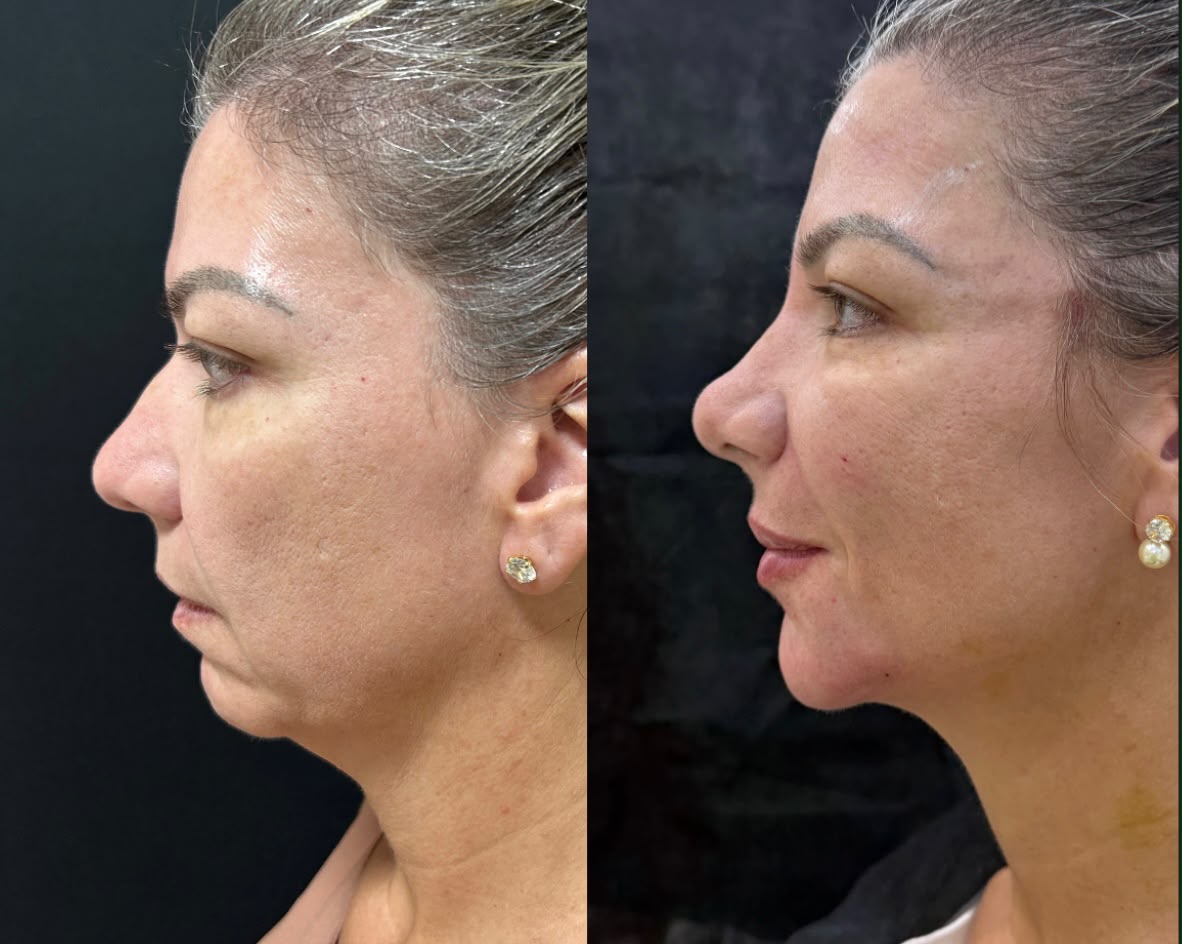 Perfiloplastia 3D - Harmonizacao Facial